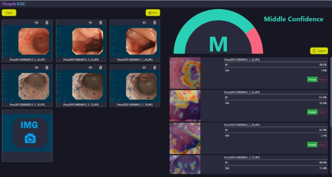早期胃癌深達度診断支援システム Deepth-EGC イメージ